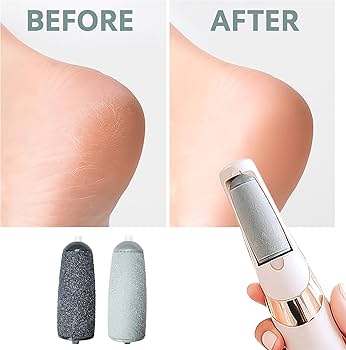 Dead skin remover