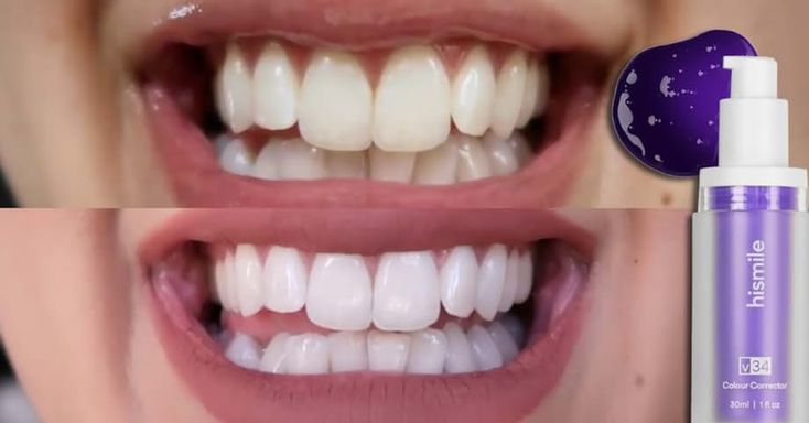Teeth Whitening