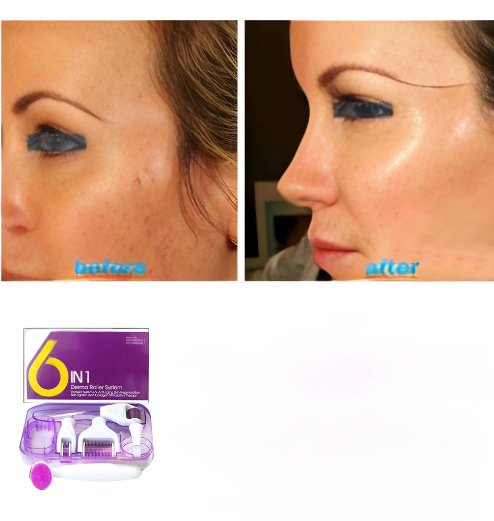 6 in 1 Derma Roller System